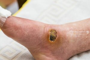 Diabetischer Fuß